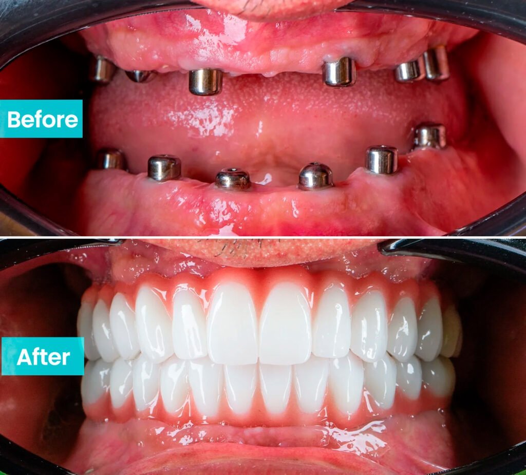 3 on 6 dental implants in Turkey by Amazing Smile Antalya clinic